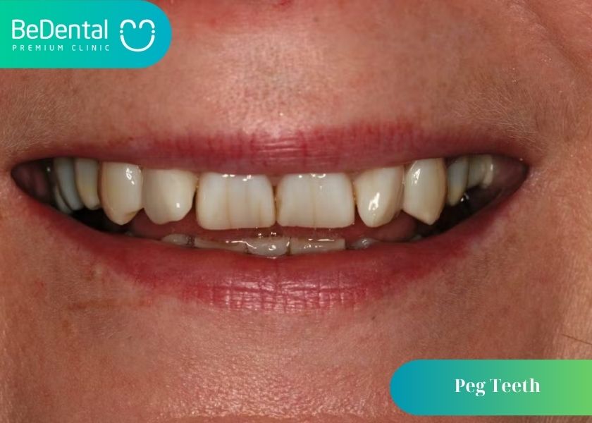 What are peg teeth? What kind of person is a person with peg teeth? How to fix peg teeth? Where to fix peg teeth in Hanoi?