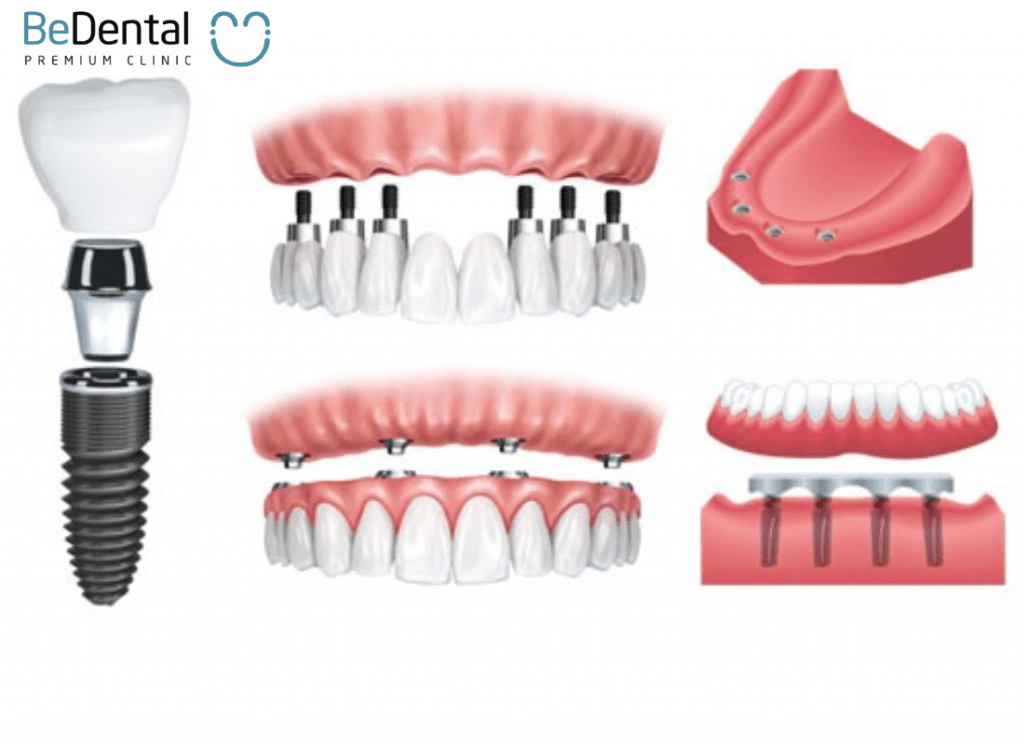 What is an implant-supported removable denture