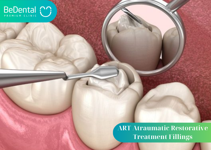 Atraumatic Restorative Treatment Fillings: Why is ART a suitable dental filling technique for children? 4 benefits ART tooth filling technology brings. ART filling process at BeDental