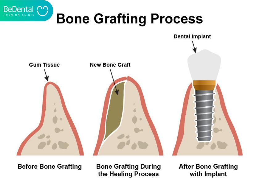 Type of bone to be implanted. What should bone graft eat to heal the wound quickly? Why is dental bone graft surgery necessary?