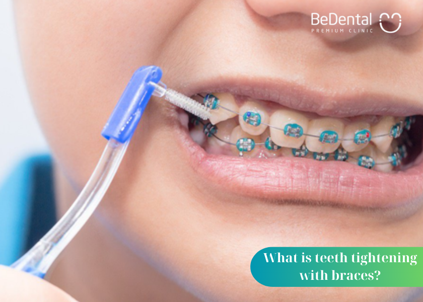 Why is it necessary to tighten teeth with braces? How often should you tighten your teeth with braces?