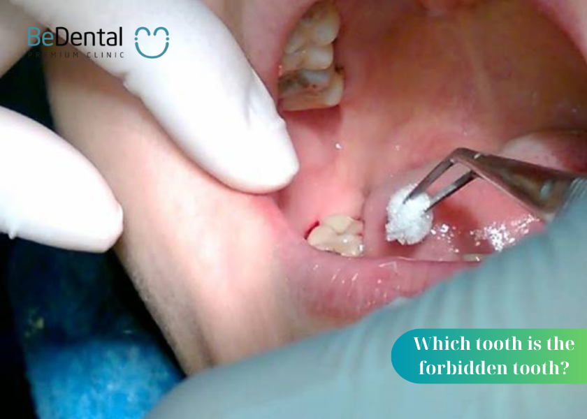 Which tooth is the forbidden tooth? When is it necessary to have a tooth extracted? Dangerous complications when applying tooth extraction at home