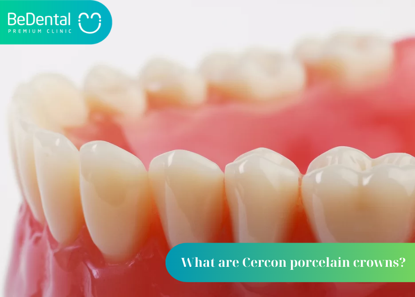 What are Cercon porcelain crowns? Are Cercon porcelain crowns good? How much do Cercon porcelain crowns cost?