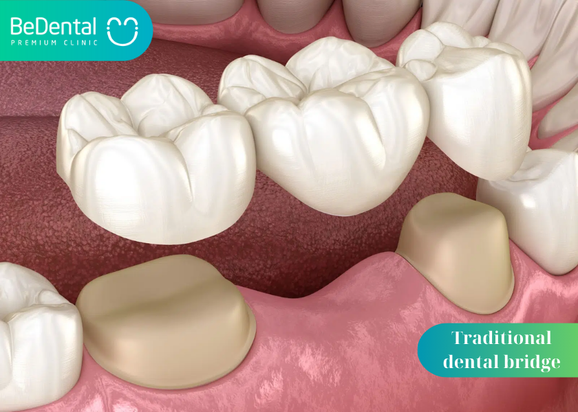 What material is a dental bridge made from? Is a dental bridge durable? The 5 most popular types of dental bridges