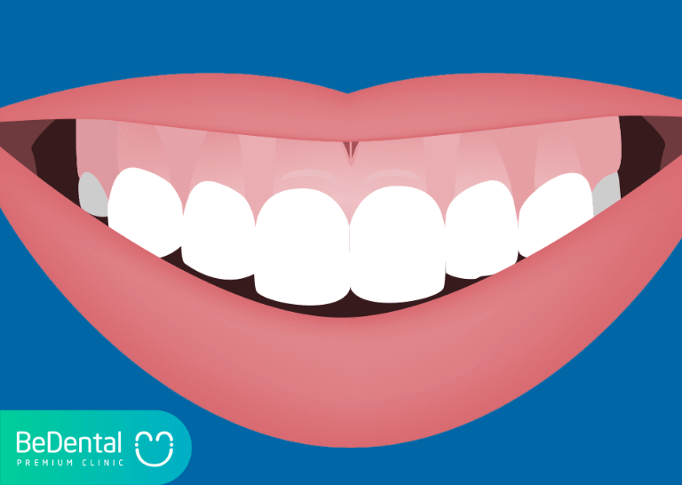 cười hở lợi là sướng hay khổ