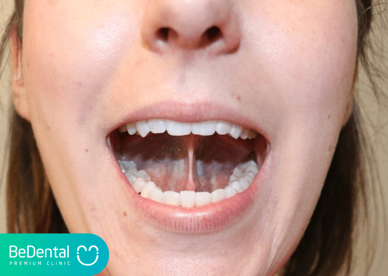 Dính Thắng Lưỡi: Nguyên Nhân, Dấu Hiệu và Cách Điều Trị 3 dính thắng lưỡi