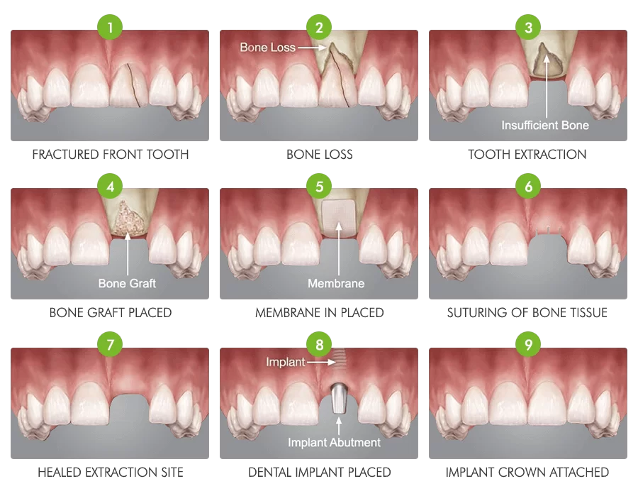 How long does it take for bone graft surgery to heal? 5 factors that determine how long it takes