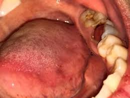 Bị vỡ răng có sao không?