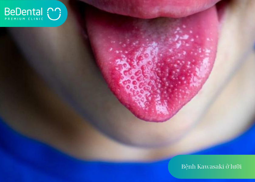 Tình trạng lưỡi khi mắc bệnh kawasaki