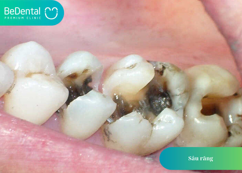 Nguyên nhân gây ra sâu răng là gì?
