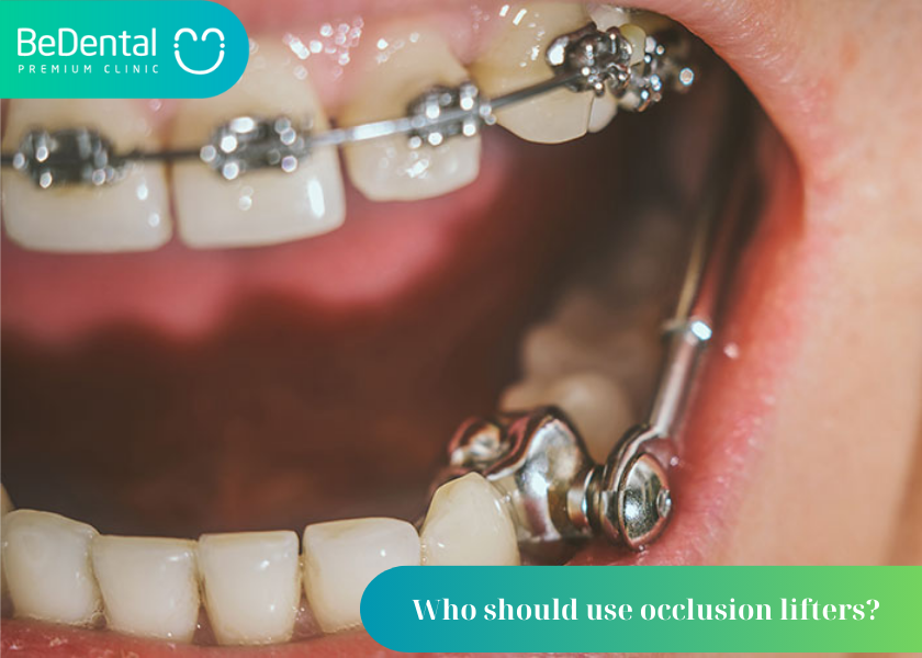 What is a removable joint lift in braces? Who should use occlusion lifters? How long does it take to lift the bite with braces?