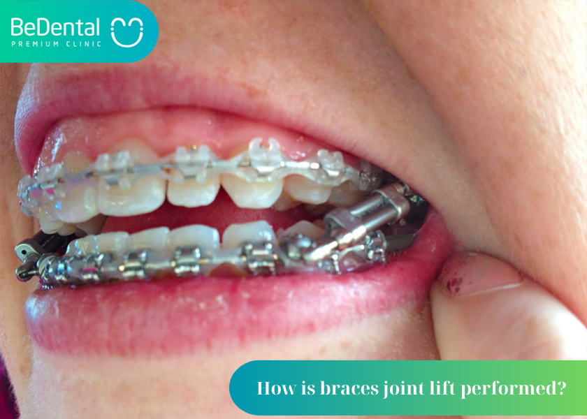What is a removable joint lift in braces? Who should use occlusion lifters? How long does it take to lift the bite with braces?