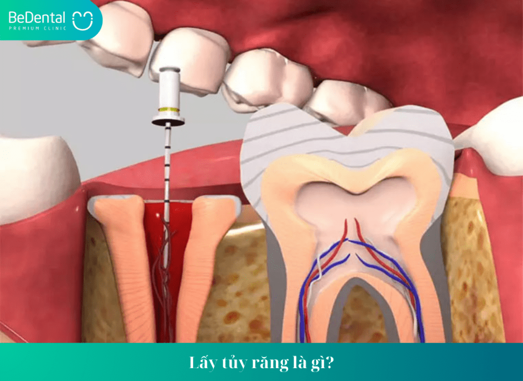 Lấy tủy răng phục hồi sức khỏe răng miệng