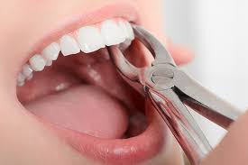 Nhổ răng sai cách ảnh hưởng đến sức khoẻ răng miệng không thể thay đổi vận mệnh