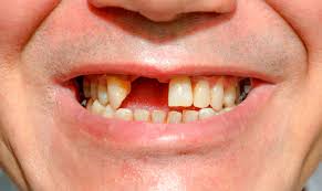 Gãy răng ảnh hưởng đến phong thuỷ