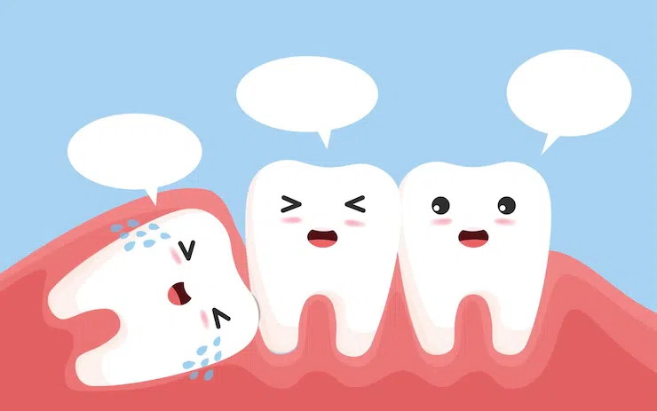 Răng khôn mọc lệch nhưng không đau có nên nhổ? 