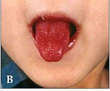 Tình trạng lưỡi khi  mắc bệnh kawasaki