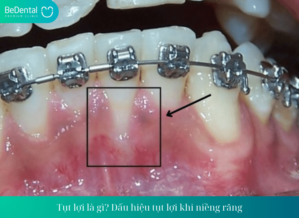 Tụt lợi là gì? Dấu hiệu tụt lợi khi niềng răng