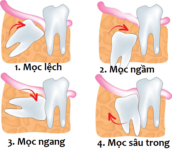 26 nho rang khon ham duoi bao nhieu tien 1