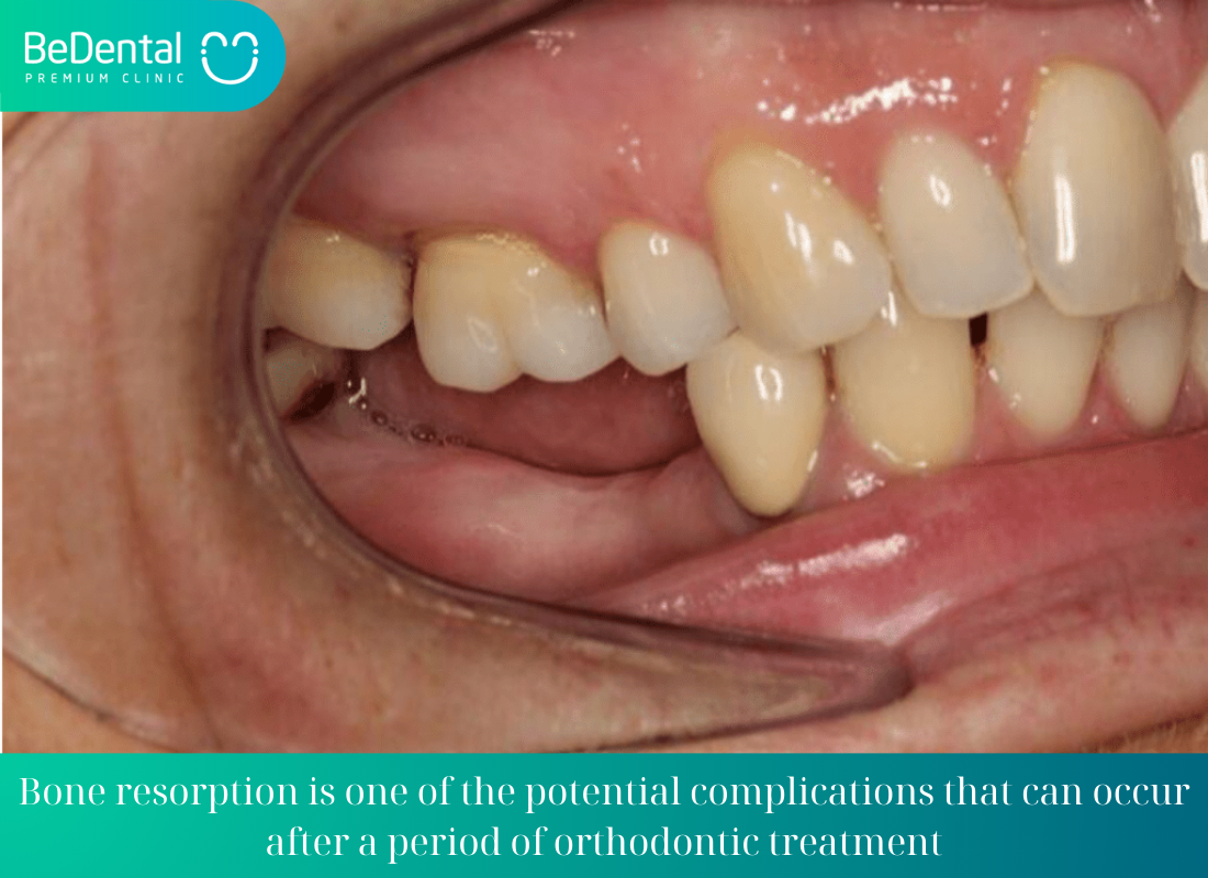 Bone resorption is one of the potential complications that can occur after a period of orthodontic treatment