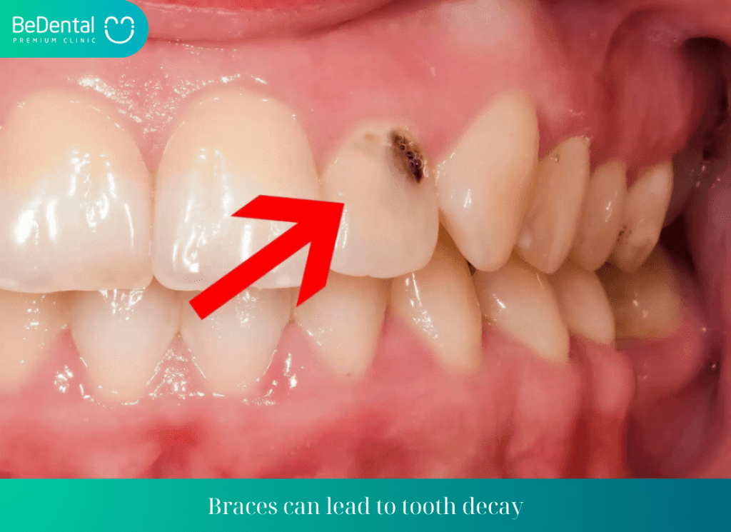 Braces can lead to tooth decay