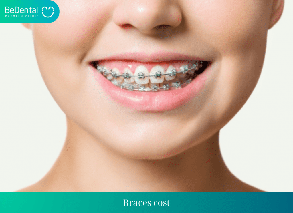 What are the cost of braces