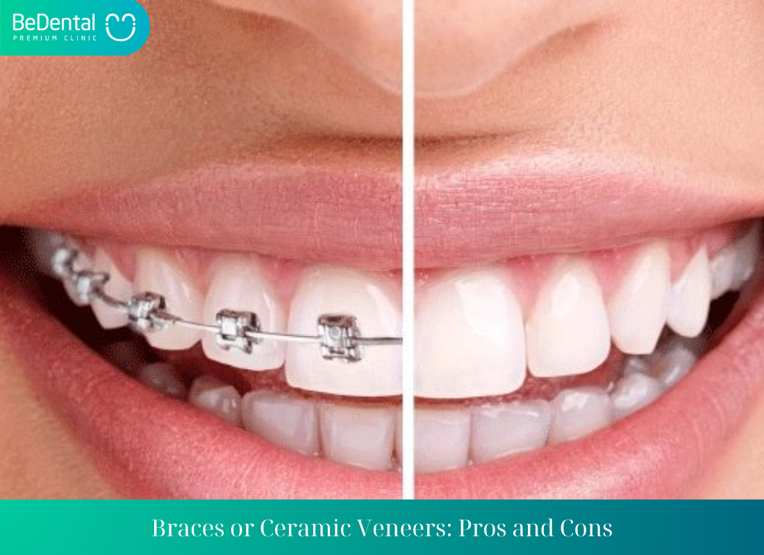 Braces or Ceramic Veneers