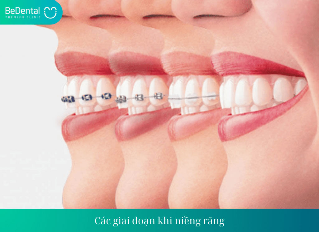 Các giai đoạn khi niềng răng