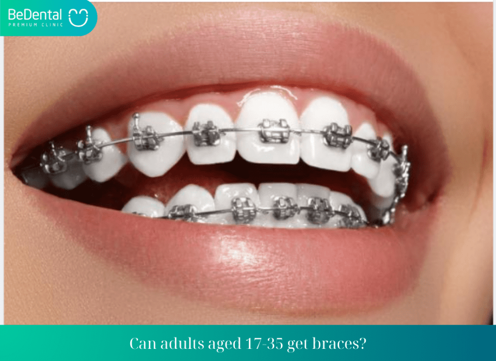 Can adults aged 17 35 get braces