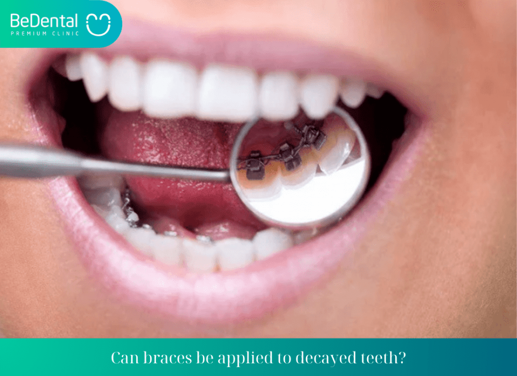 Can cavities be braced