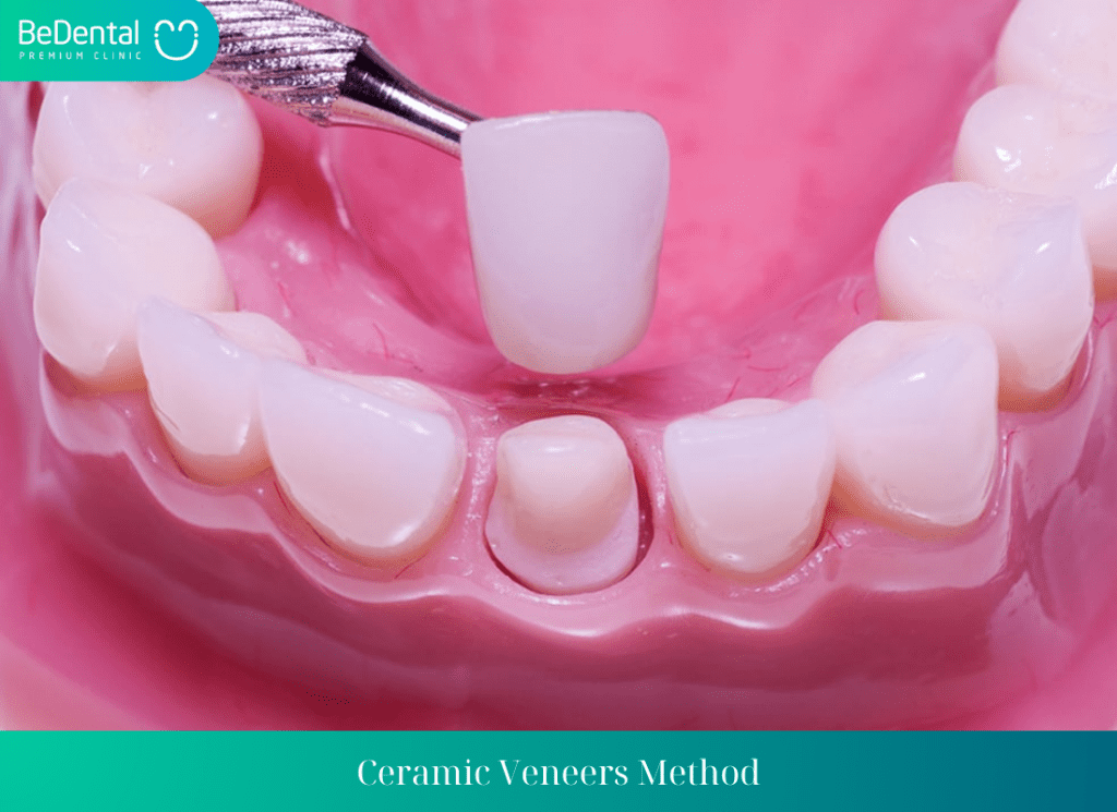 Ceramic Veneers Method