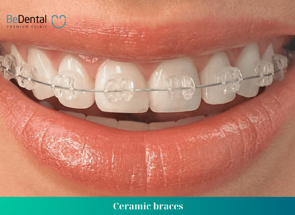 Ceramic braces