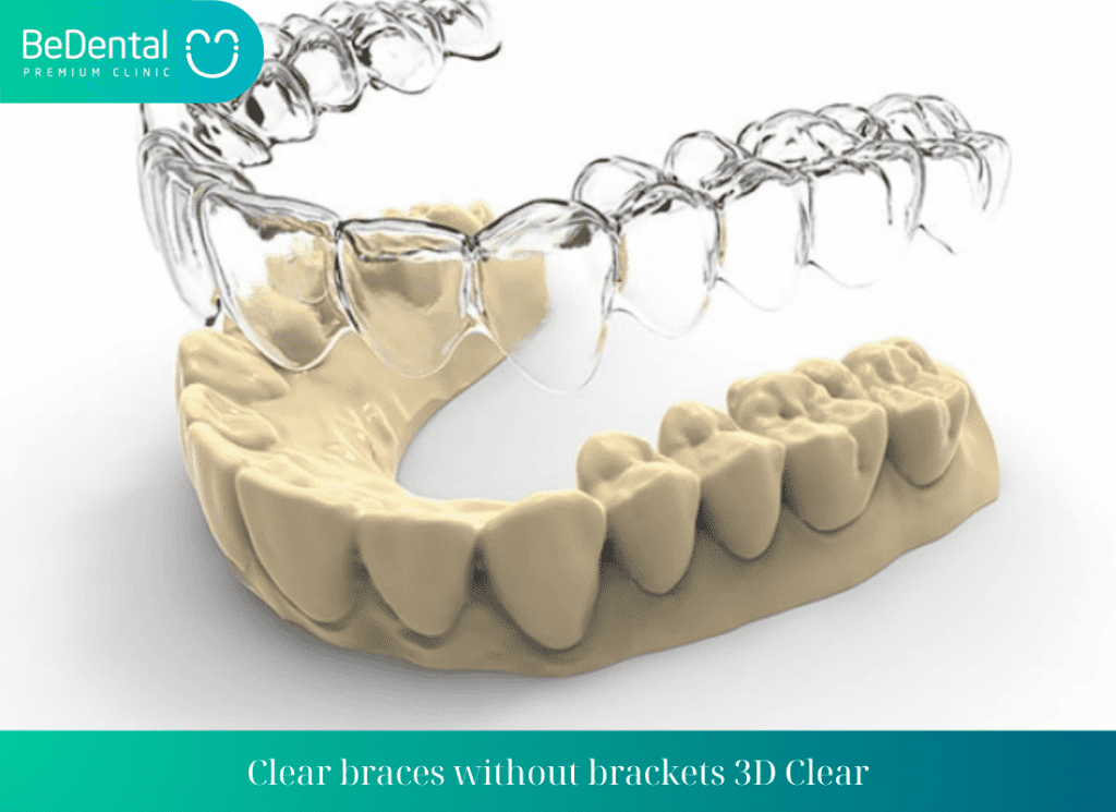 Clear braces without brackets 3D Clear