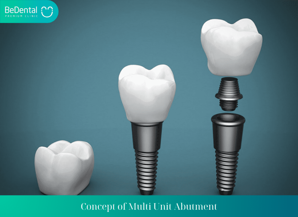 Concept of Multi Unit Abutment