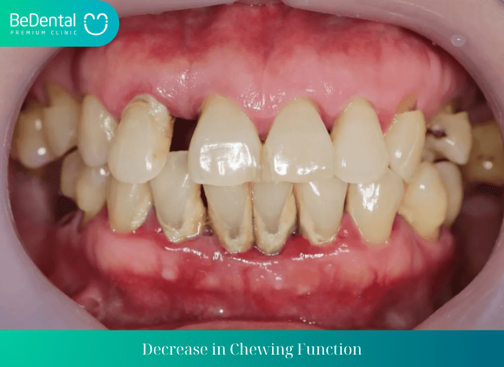 Decrease in Chewing Function