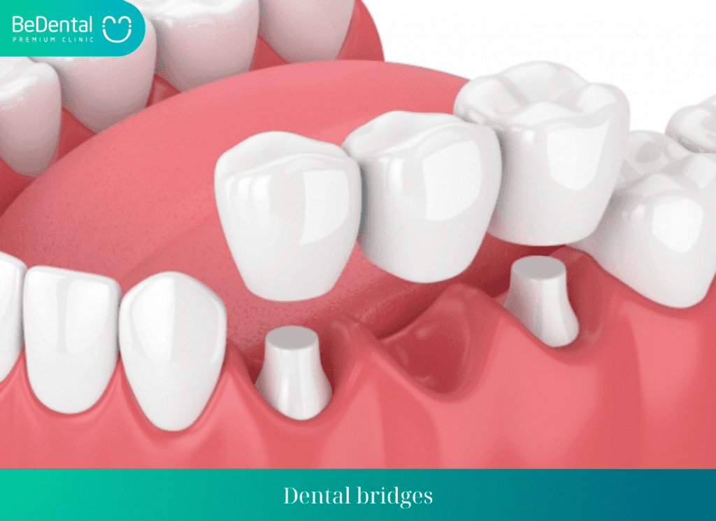 Dental bridges