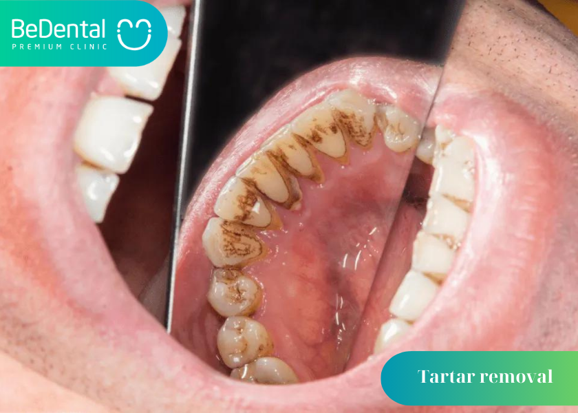 How Long Does Tartar Removal Take?