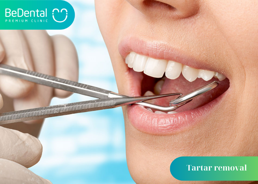 Benefits of Regular Tartar Removal