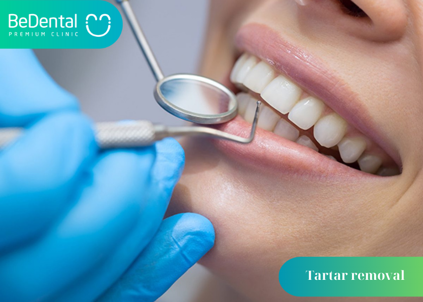 Benefits of Regular Tartar Removal