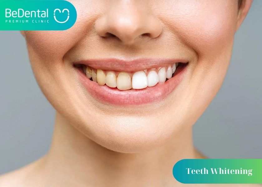 How much does affordable and reputable teeth whitening cost?