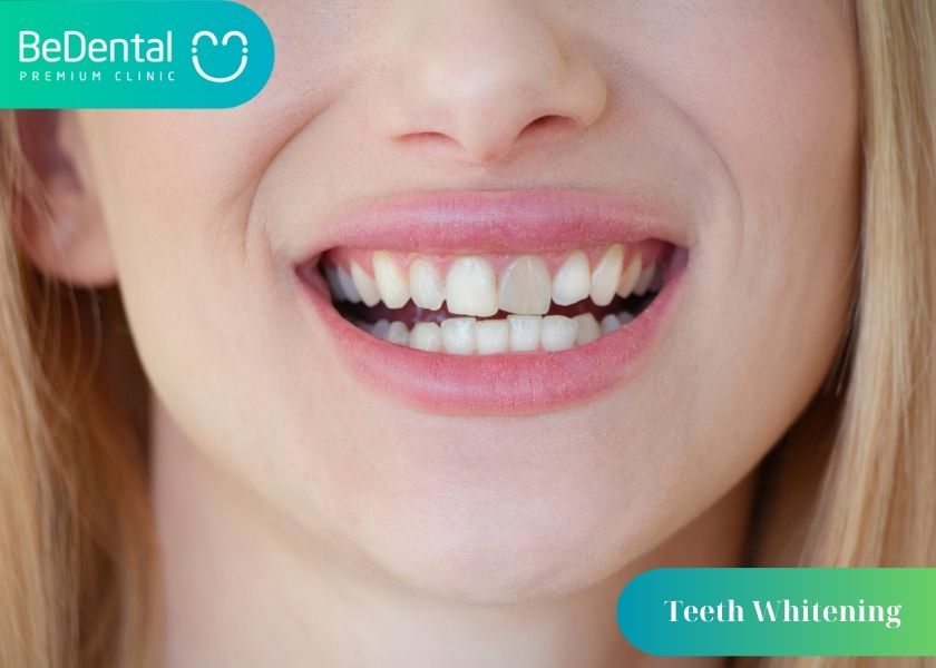 How much does affordable and reputable teeth whitening cost?