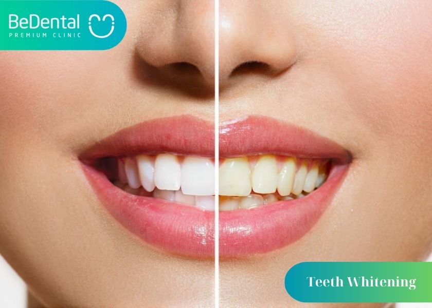 How much does affordable and reputable teeth whitening cost?