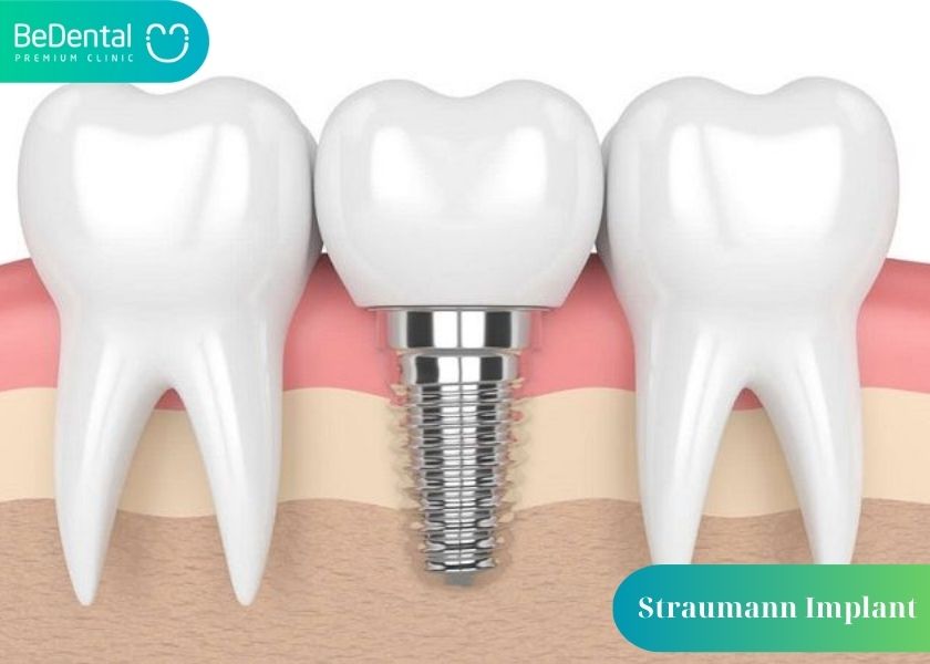 Advantages of Straumann Swiss Implants