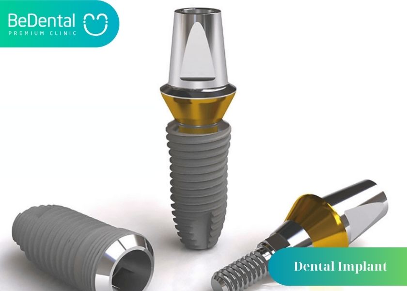 6 Advantages of Dental Implants You Should Know