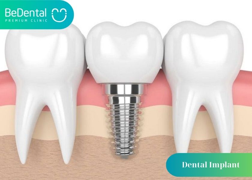 6 Advantages of Dental Implants You Should Know