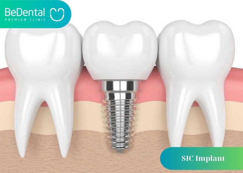 3+ Advantages of SIC Implant