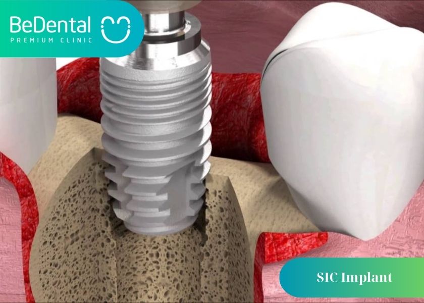 3+ Advantages of SIC Implant