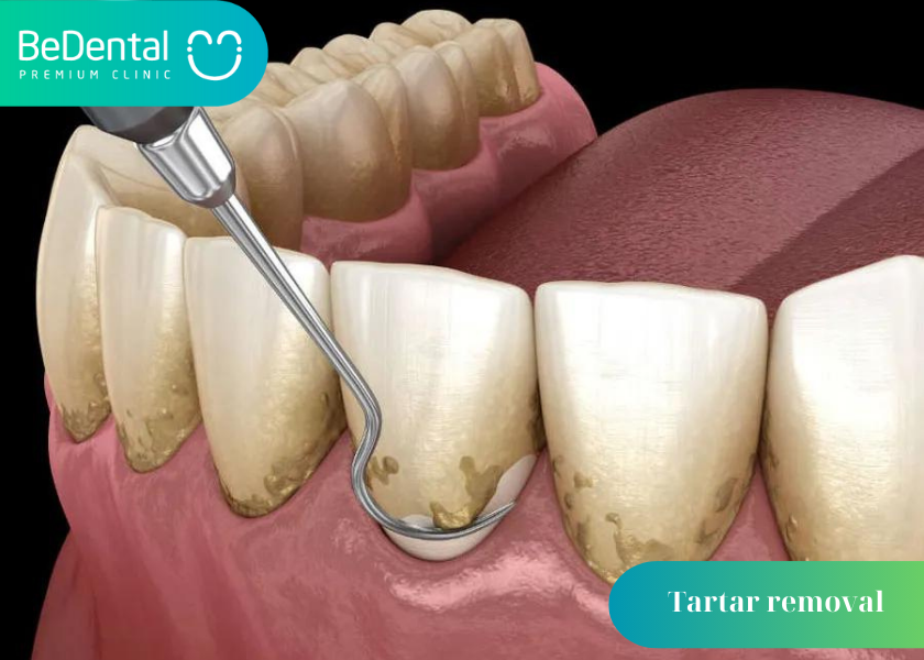 How Long Does Tartar Removal Take?