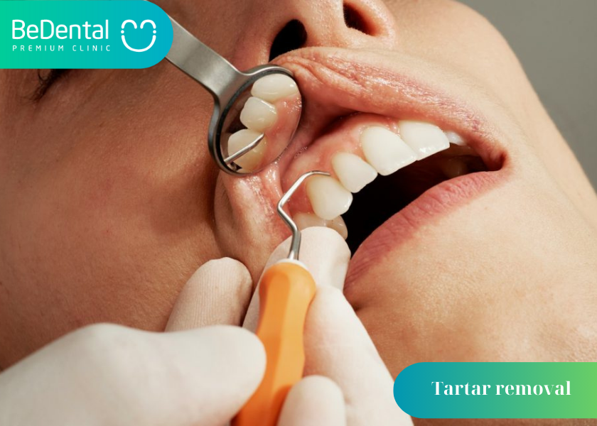 How Long Does Tartar Removal Take?