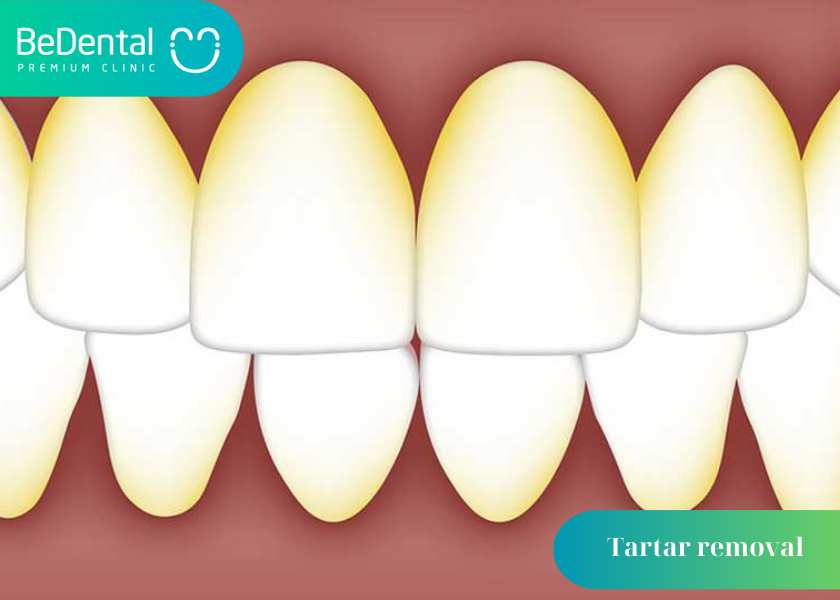 How Long Does Tartar Removal Take?